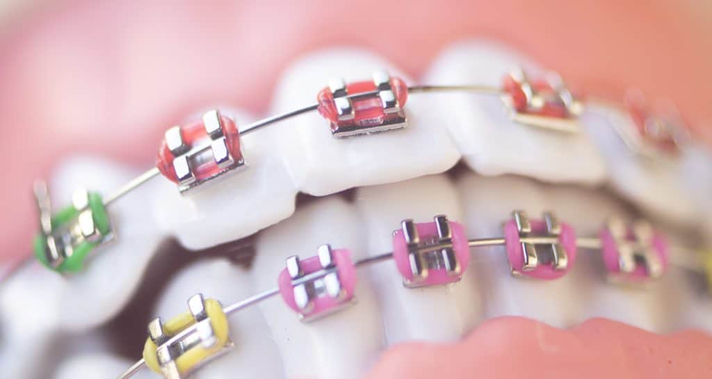 Closeup of colorful metal braces