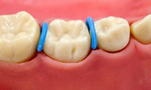 orthodontic separators